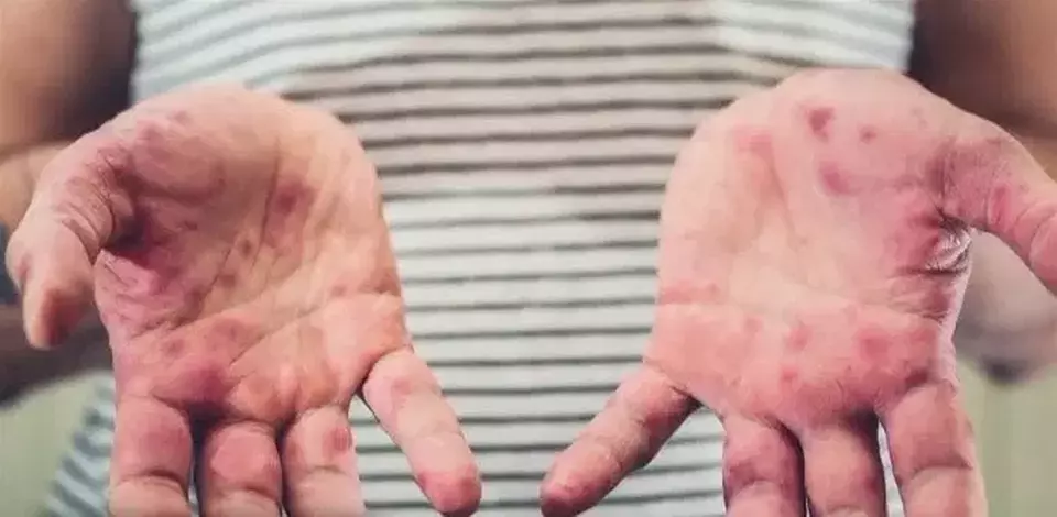 Kemenkes Tindak Lanjut Laporan Kasus Campak dari Australia