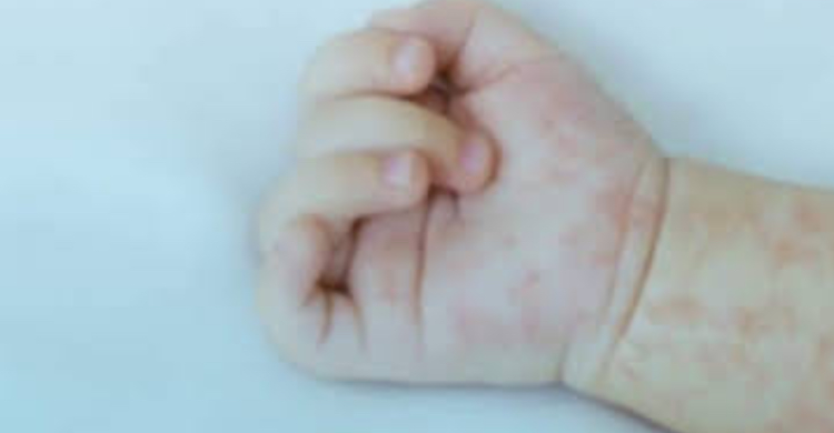 Ratusan Kasus Campak Ditemukan di Subang, Dinkes Minta Warga Waspada